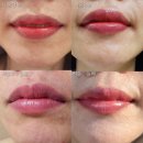 3949 | 대전입술문신, 대전입술문신 리얼탈각후, 둔산맘카페입술예약추천 ( 캐츠아이)