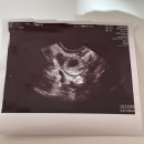 한라약국 | [자궁외임신] 임신인 줄 알았는데 수술이라니.. mtx 주사, 복강경 수술 및 회복 후기, 제주한라병원 입원