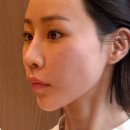 닥터김DK의원 | 신사역 올타이트리프팅 하프하게 쫀쫀해진 턱라인 피부클리닉의원 내돈내산 후기 (효과O, 다운타임X)