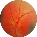 레버씨 시신경 위축증(Leber hereditary optic neuropathy(LHON)) 눈질환, 유전질환이란? 이미지
