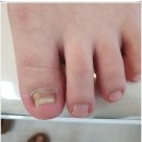 세종 소담동 발톱무좀 오랜고민 해결 발데렐라 // 내성발톱 무좀발톱 발각질