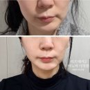 바노바기의원 | 바노바기의원 창원 리프테라2 레이저 리프팅 시술받은 내돈내산 솔직 후기 일주일 시술 경과!