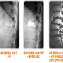 동성 보조기 이미지
