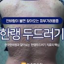 한랭 두드러기 알레르기 몸 가려움증 피부 묘기증 원인 이미지