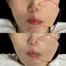 채움메디칼 | [공지] 대전피부관리 탄방동피부관리 뷰티더채움 메디컬스킨케어! 프로그램 ‘리베룩’ 도입!