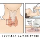 의학과한방(동영상):갑상선암 (Thyroid Cancer) 이미지