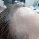 헤어24K | 가산탈모 관리 후기｜블랙에서 모100 생장술로 헤어라인 케어받은 후기