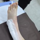 성지병원 | 강원도-원주/인동) 성지병원 발목 골절 수술 후기 (수술 당일부터 8일차까지)