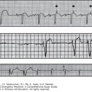 분당유도관 | Cardiac Pacing and Implanted Defibrillation - 응급의학 033