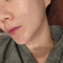 안 | 압구정피부과 티타늄 솔직후기! 안아프게 쫙 붙어요!