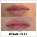 맑은피부에스테틱 - 서구 | 창원 어반브릭스 맑은피부에스테틱 입술볼륨관리 내돈내산 재방문