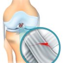 [콕!건강]야외 활동 많아지는 봄…&#34;십자인대파열 주의하세요&#34; 이미지