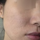 울트라펄스알파 4개월 경과 솔직 후기, 여드름패인 흉터 치료 (비포애프터)