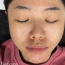 트렌디뷰티 | 💆‍♀️ [대전/유성구] 설브 봉명본점 – 트렌디뷰티샵 여드름케어 후기