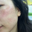 대구에스테틱 홍화뷰티, 동촌유원지 메디컬 기미관리 후기