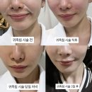 더 귀족 | 강남피부과 팔자주름 시술 귀족침 동안얼굴 만들기 효과 시기 비용 붓기 후기