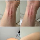 알레르기 비염 완치? 피하면역주사 2년차 후기