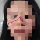 한강수병원 | 한강 수병원 얼굴 열상 봉합 후기1 (피 사진 주의)