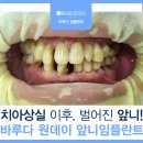 희망치과기공소 | 치아상실 이후, 방치로 벌어진 앞니! 그 임플란트에 대하여_바루다 원데이 앞니 임플란트
