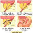 '순한 암'이라고? 증상 나타나면 이미 3기…韓남성 발병 늘었다 이미지