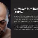 TS광학 | 💇‍♂️ M자 탈모 치료법, 되돌릴 수 있을까?