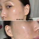 강성호피부과의원 | <아토피 탈스 기록 12탄> 피부 근황, 그리고 여드름관리와 스킨케어샵 ㅣ 전주 미니뷰티