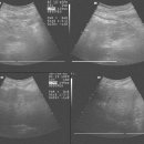 LC & ascites & pancreatitis 이미지