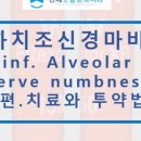 D-6 | 매복 사랑니 발치 후기 (~D+6)