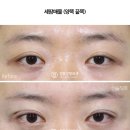 DB. Care (디비케어) | 쌍수재수술 병원 붓기 회복기간 부담적은 곳을 찾는다면