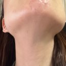 제이나피부과의원 | 피부과레이저 텐쎄라 리프팅관리 내돈내산 후기