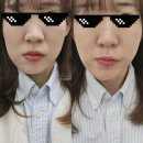 얼굴축소경락 비용 확인, 가인미가 신논현점 얼굴 크기 전후 비교