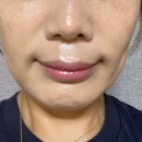 ㈜푸름바이오 | 동탄피부과 수원인계동피부과 천연리프팅 쳐진볼살 팔자주름 2회차 후기