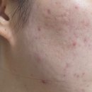(주)이소 | 여드름 n년차 괜찮은 보조제 찾음💊🥴| 이소페린 실사용 후기
