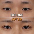 더(The)예쁜얼굴만들기성형외과의원 | 절개 쌍꺼풀수술, 또렷한 라인 완성! 신사역 치유 성형외과