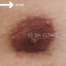 에스에이치(SH)성형외과의원 | 여유증 수술 후기 중 가슴 수술 흉터로 인해 더욱 깊은 고민을 하시는 경우가 많은 것 같습니다.