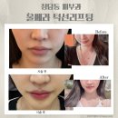 디자인선 | 청담동피부과 울쎄라 내돈내산 후기