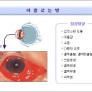 여름 장마철엔 전염성 눈병 조심하세요. _서경률 교수 (연세대 세브란스병원 안과학교실) 이미지