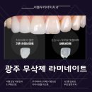 디메넥스 치과기공소 | 광주 무삭제 라미네이트 가능한 이유가 궁금하다면