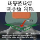 척추협착증 원인과 증상/ 어떻게 치료할까 이미지