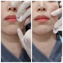 도곡역 피부과 튠베이스 쥬베룩 볼륨 팔자주름 찐후기
