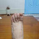 기독병원길 | 두암기독병원 하지정맥류 수술 후기: 발등 혈관 통증, 드디어 해결했어요!