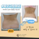 지방흡입후기 복부+허벅지+팔뚝라인의 변화 이미지