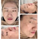 씨유 검단프라자 | 검단 청라 기미흑자 피부관리 비비드엘 인천점 후기 | 잡티개선 피부톤 밝아짐 케어 리뷰