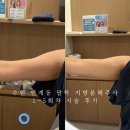 멍이랑 양이랑 | 수원 인계동 한의원 지방분해주사 1~5회차 팔뚝 신부관리 솔직 후기