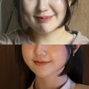 혹부리한의원 | 청담피부과 다운타임 없는 티타늄리프팅 80줄 통증없음 팔자주름 후기