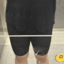 디펫 | 허벅지지방추출주사 디팻주사 한달차 후기