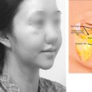 서울cs성형외과 코메디닷컴