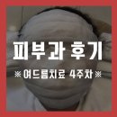 [피부일기] 4주 내내 피부과 다닌 후기