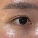 공주사 | 눈밑 다크서클 주사 결절없는 아이공주사 후기