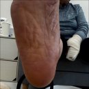 화성 산척동 발각질 제거로 삶의 질 상승 무드비네일 닥터아이티엔 화성점 내성발톱 무좀 발각질